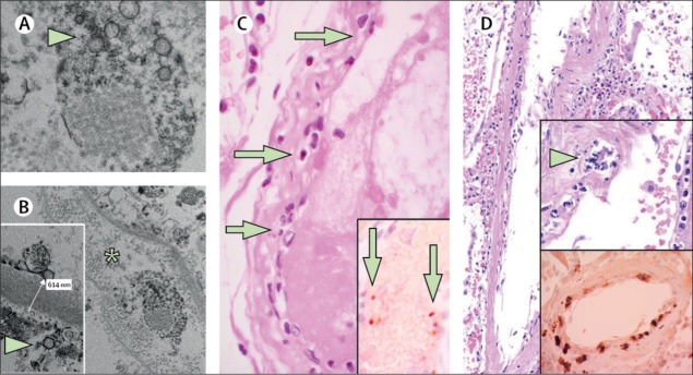 Infection des cellules endothéliales et endothéliite dans le CO