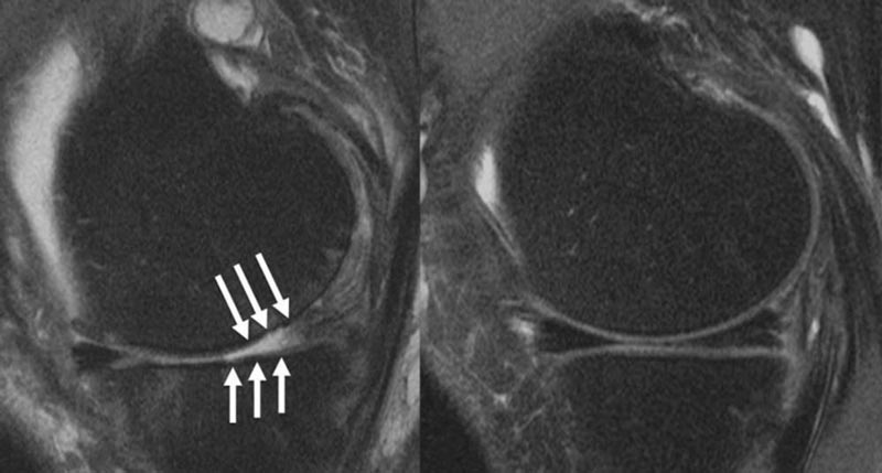 Les injections de corticostéroïdes exacerbent l’arthrite du genou