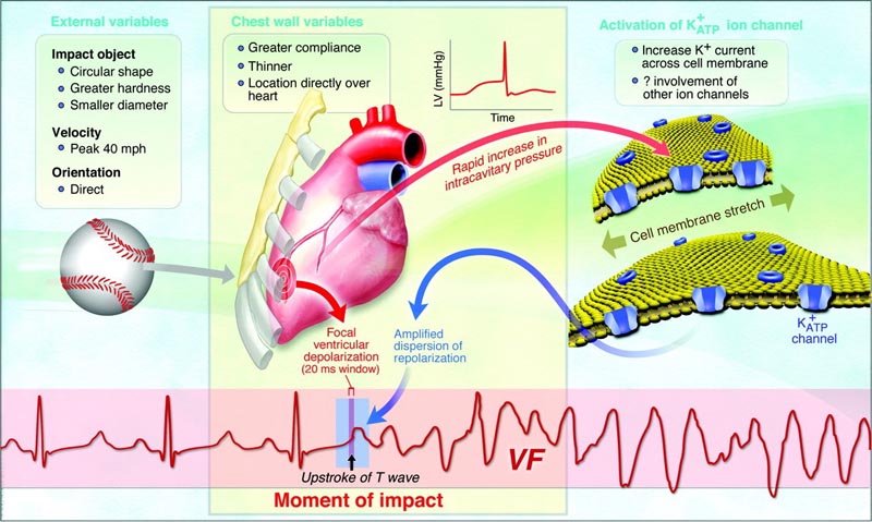 Was ist Commotio Cordis?