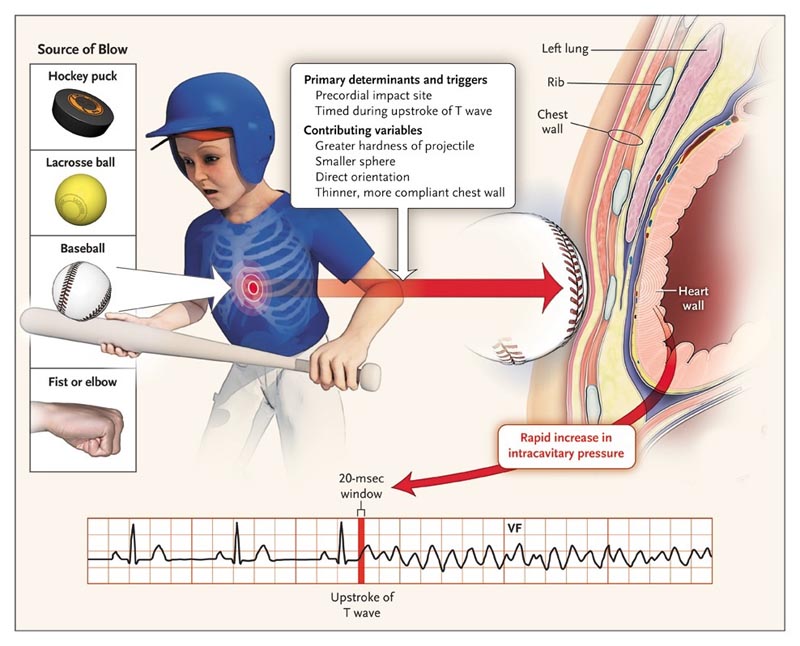 Was ist Commotio Cordis?