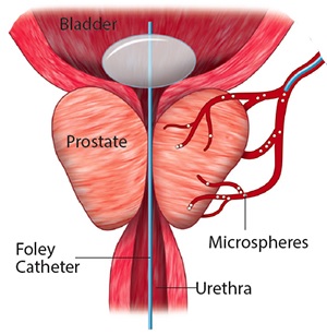 Embolisation de l’artère prostatique : efficacité à long terme