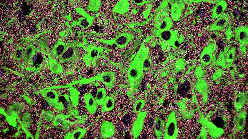 Un mécanisme neurodéveloppemental pourrait être associé