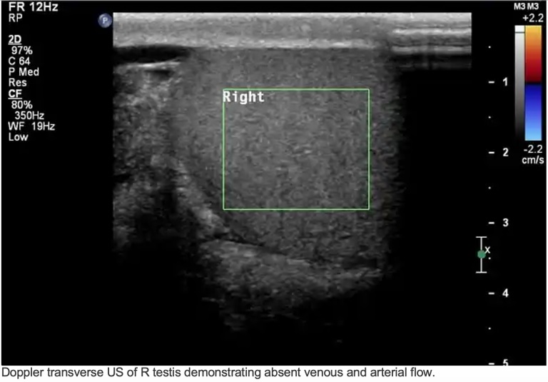 Torsion testiculaire : reconnaître une émergence urologique