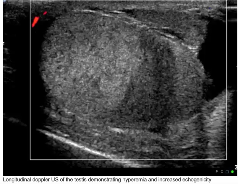 Torsion testiculaire : reconnaître une émergence urologique