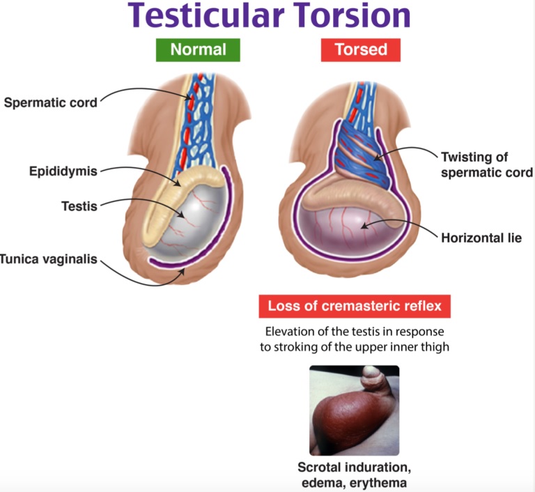 Torsion testiculaire : reconnaître une émergence urologique