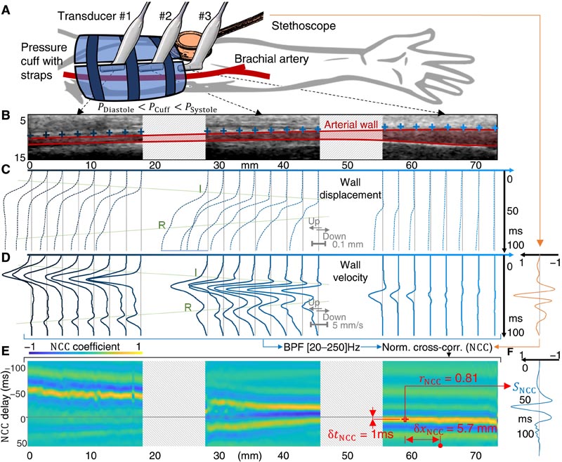 Mechanisms of Korotkoff Sound Generation