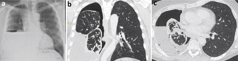 Versamento pleurico unilaterale: revisione clinica