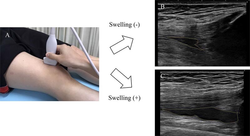 Infiammazione soggettiva del ginocchio nell’osteoa