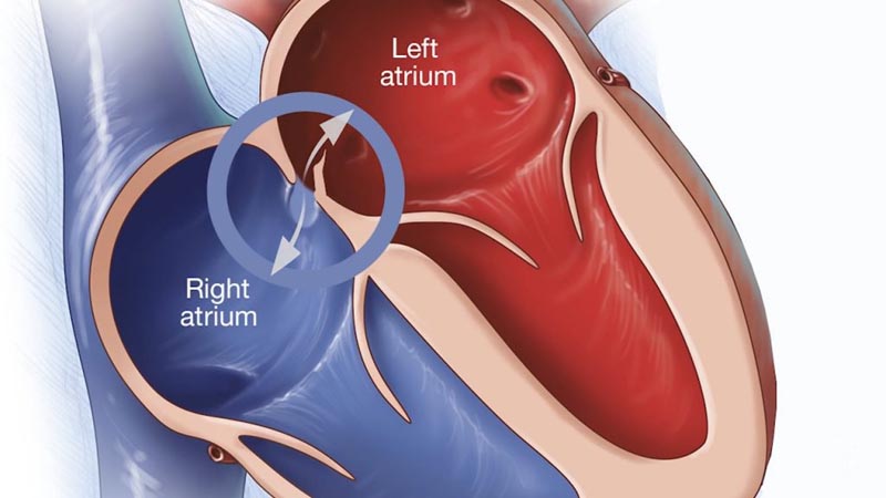 Sélection des patients pour la fermeture du foramen ovale breveté