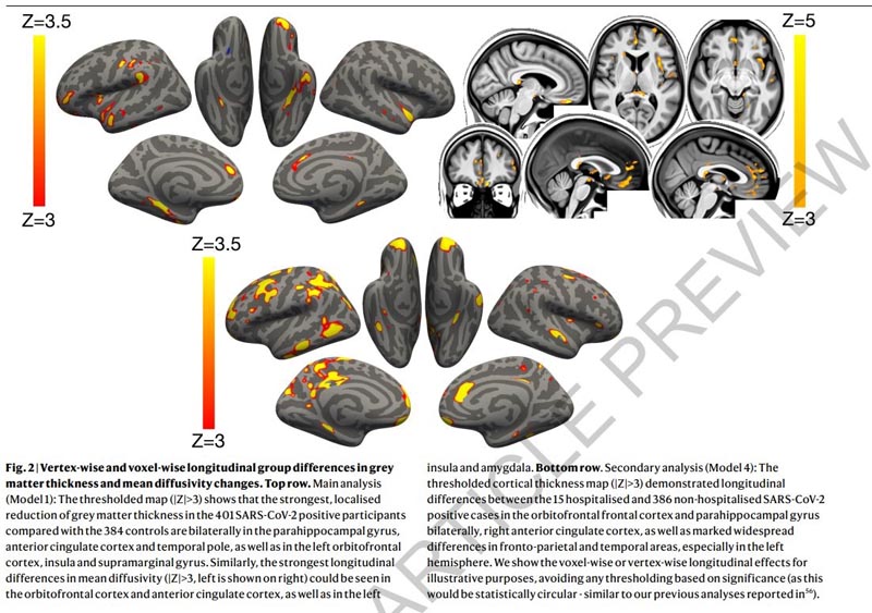 Modifications structurelles du cerveau associées au SRAS-CoV-