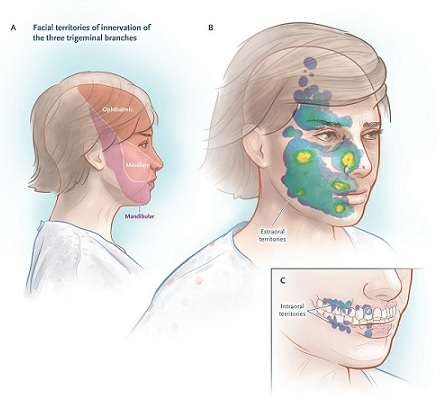 Nevralgia del trigemino: caratteristiche cliniche