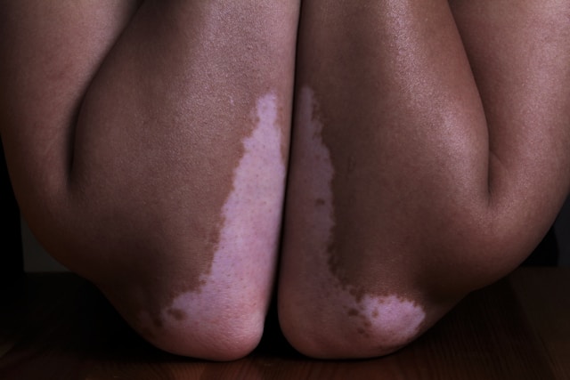 Vitiligo in Children and Young Adults