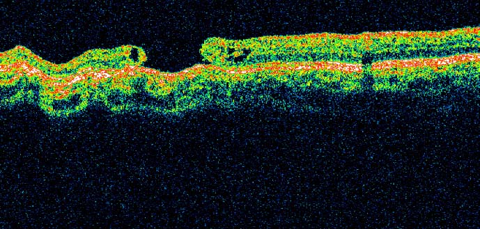 Retinal thickness as a biomarker in Parkinson´s d