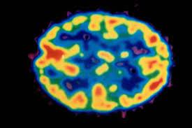 Cocaine Use and the Brain